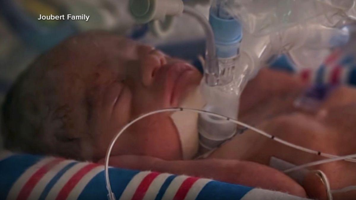 Miracle baby 'born twice' after undergoing groundbreaking surgery
