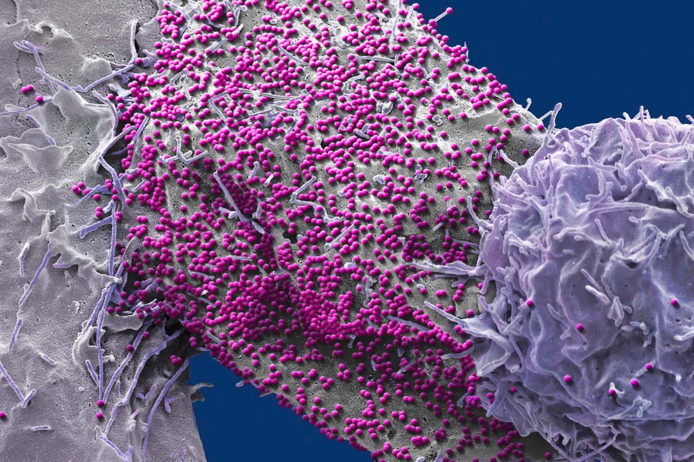 A man has unexpectedly been cured of HIV after receiving a transplant of non-HIV-resistant stem cells