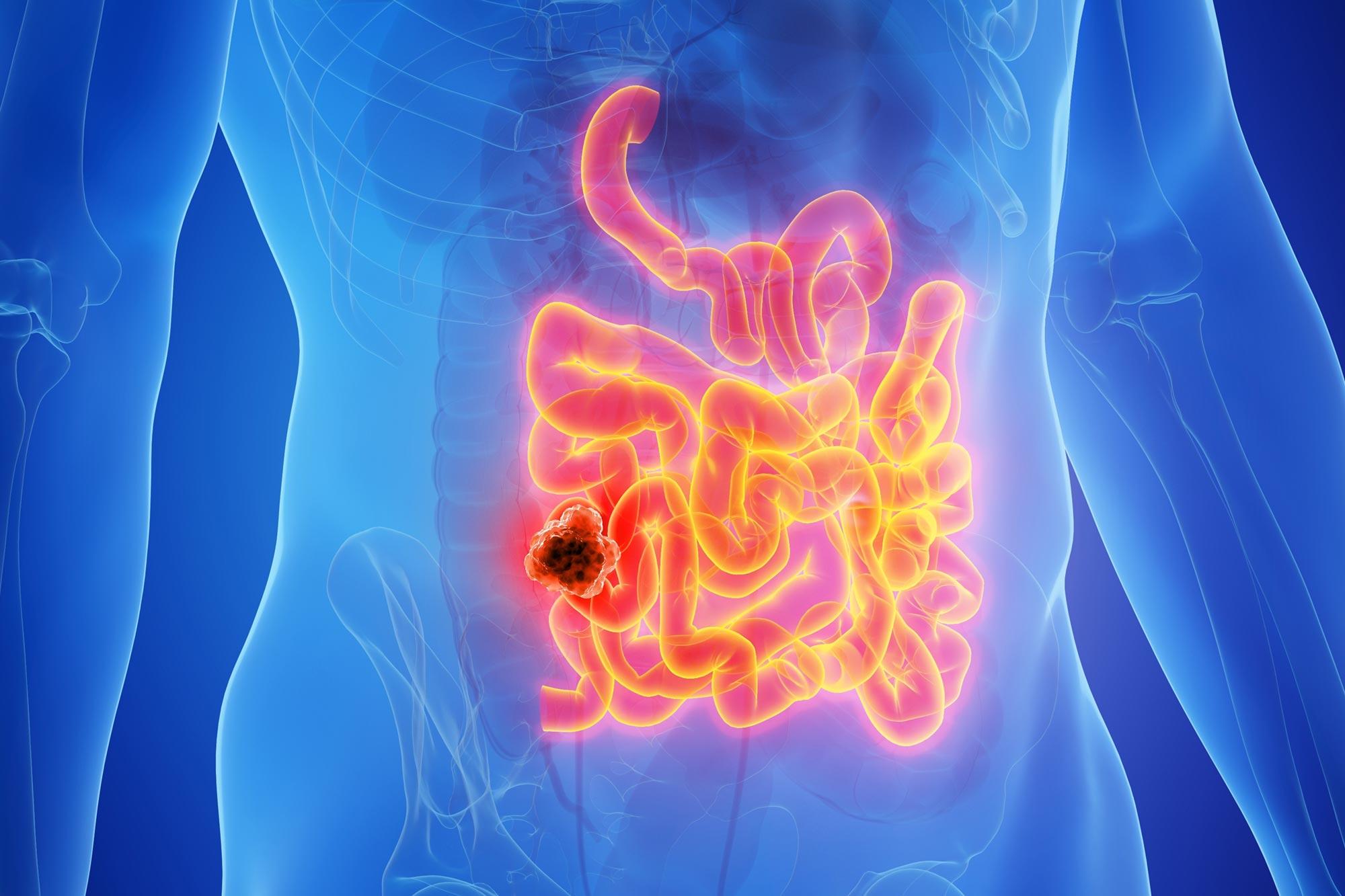 Breakthrough Bowel Cancer Trial Leaves Patients Cancer-Free for Nearly 3 Years
