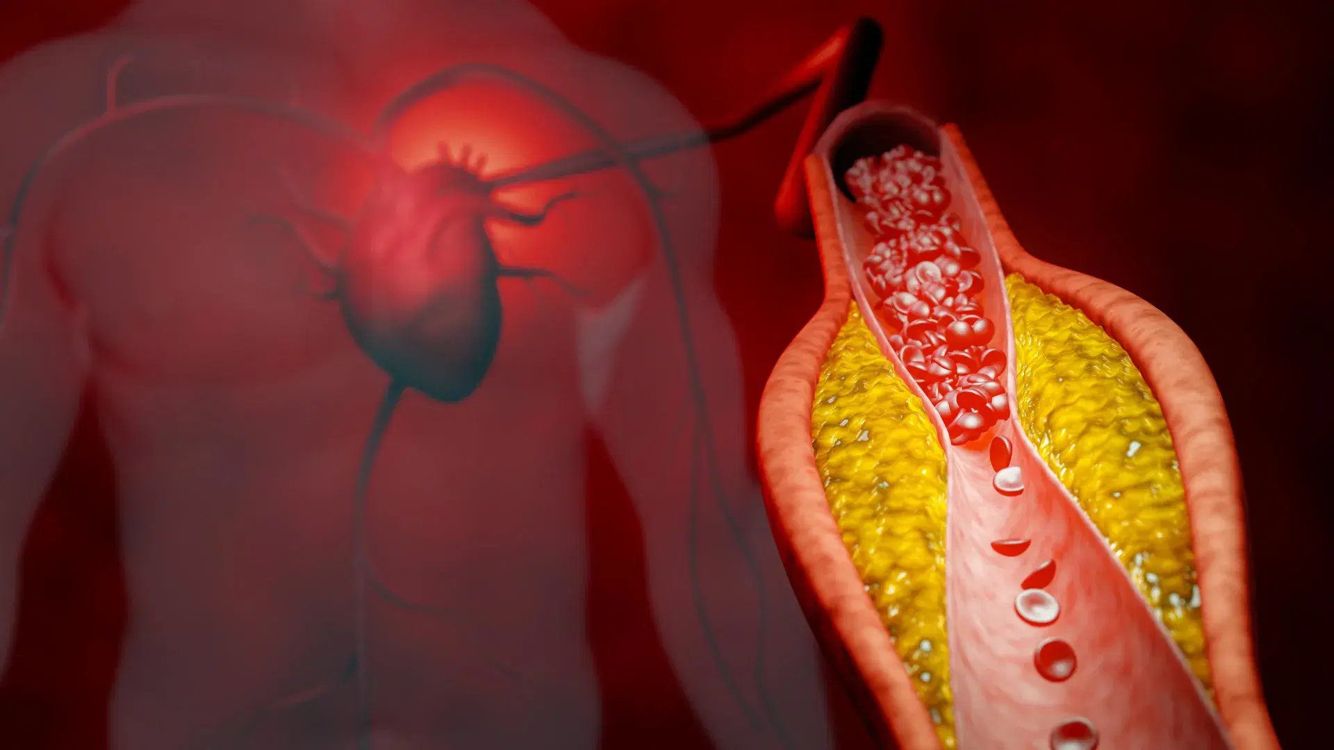 New treatment cuts bad cholesterol by nearly 50% without statins
