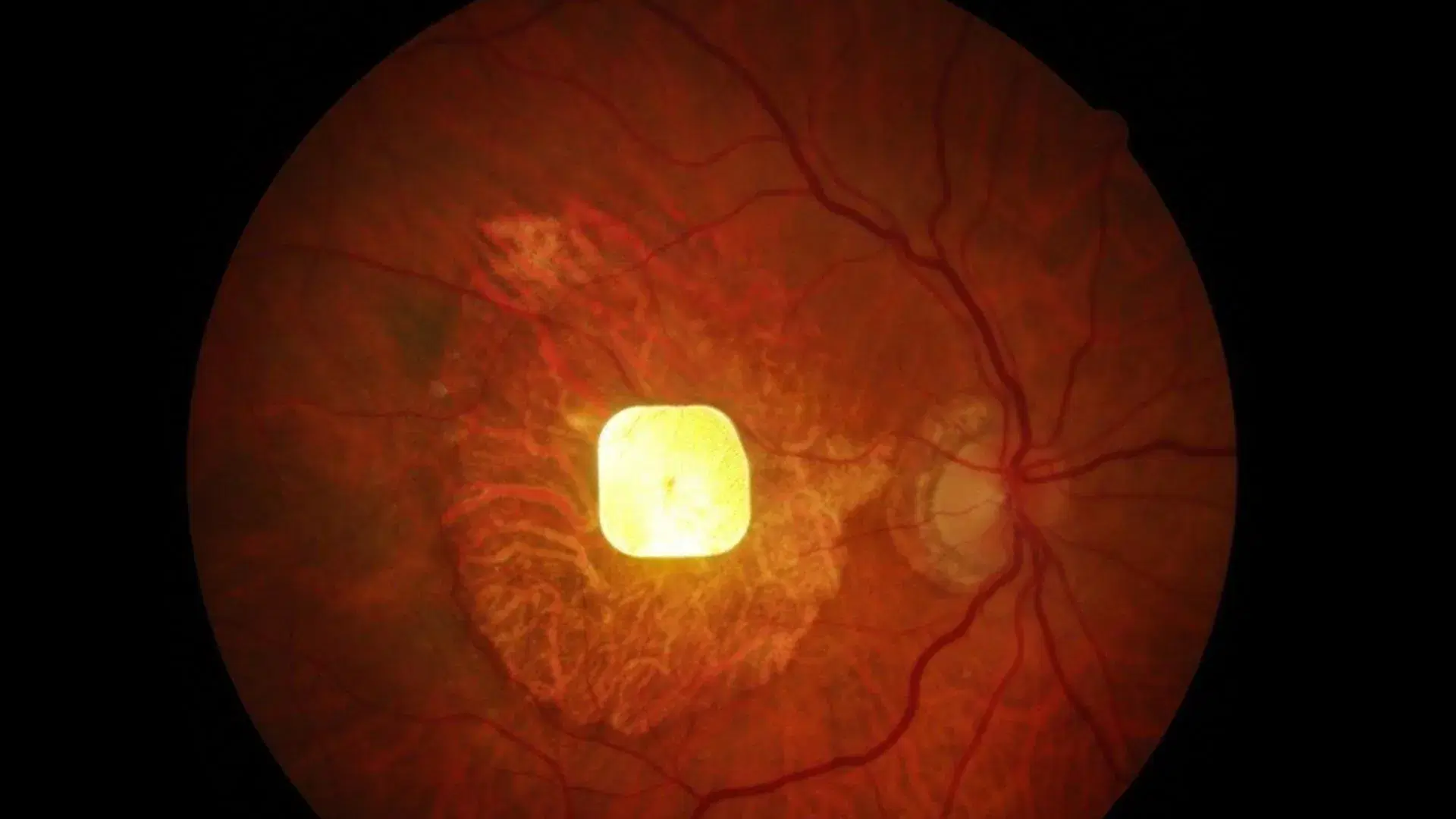 A Wireless Chip in the Eye Restores Sight to Blind Patients The Future of Medicine Is Here